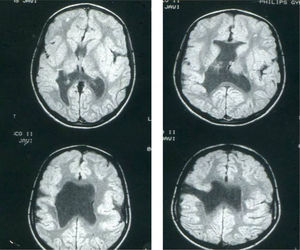 Case 4: unilateral open-lip schizencephaly in a 5-year-old child. Four axial slices at different levels; only 1 shows the schizencephaly in the right hemisphere, while cortical–subcortical dysplasia can be seen in a number of regions in both hemispheres. Septum pellucidum is absent and corpus callosum is very thin.