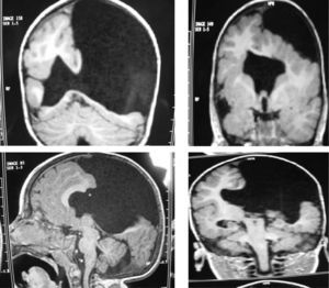 Case 11: bilateral open-lip schizencephaly in a 3-year-old boy. 3D MRI study showing different images of the brain.