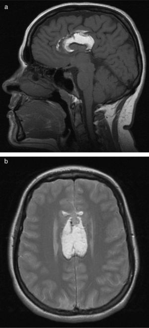 Brain MRI. (a) T1-weighted sagittal slice: hyperintense lesion in the area of the corpus callosum, which is absent. (b) T2-weighted axial slice: hyperintense lesion in the corpus callosum area. Agenesis of the corpus callosum with separation of the lateral ventricles.