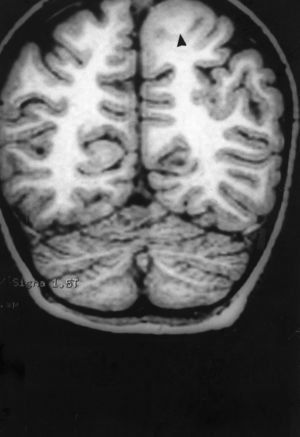 Case 1: Coronal 3D MRI slice. We observe a medium-sized FCD in the parasagittal region of the left posterior parietal lobe (arrow). Note the thickening of the FCD, the loss of differentiation of cortical grey matter, the indistinct junction between the cortex and subcortical white matter, and signal changes inside the FCD.