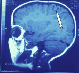 Case 3: Sagittal T1-weighted MRI slices showing an FCD in the parietal region with a moderate U-shaped hypointensity in the cortex and underlying white matter (arrow).