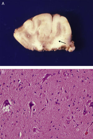 Anatomical and histological study of the surgical specimen from the same patient. (A) Extracted neurosurgical specimen. The cortex displays variations in width and the white matter shows areas of subcortical demyelination tracing a U-shape, as was apparent on the MRI scan (arrow). (B) Histological study of the cerebral cortex showing structural changes, dysmorphic and poorly distributed neurons, and reactive gliosis. H&E stain 200×.