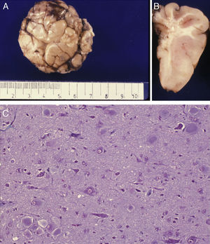Anatomical and histological study of the surgical sample from the same patient shown in Fig. 5. (A) External appearance of the surgical sample shows severely deformed folds and sulci. (B) Lateral slice of the surgical sample shows irregular cortical thickness with highly myelinated white matter. (C) Histological preparation in which we observe isolated or grouped balloon cells in the cerebral cortex. Masson's trichrome stain 200×.
