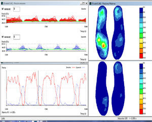 Graph of instrumented insole readings from a hemiplegic patient (from right to left and top to bottom): pressure sensors; maximum pressures; forces; isobars.