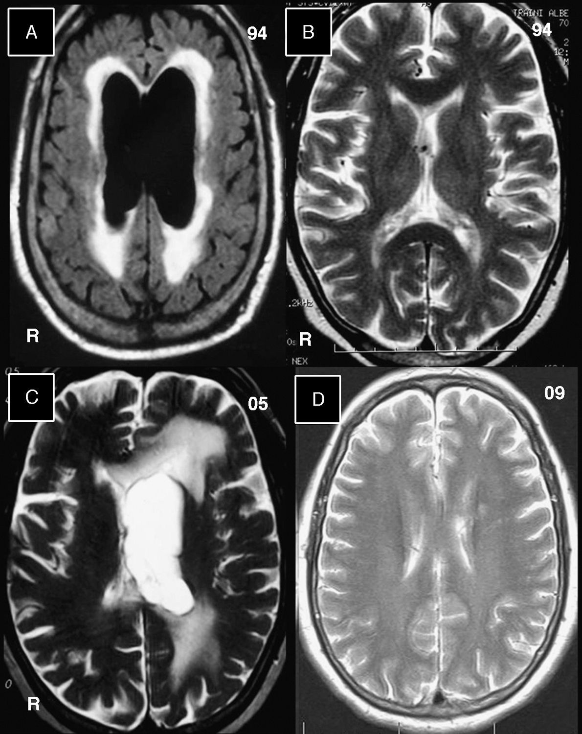 Whipple's disease: Multiple systemic and neurological relapses ...