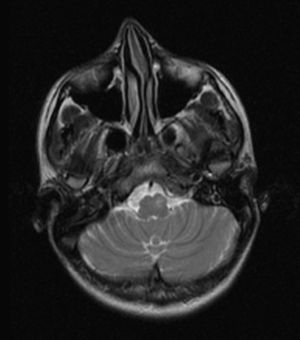 Axial T2-weighted MR image. Hyperintensity, increase in volume and changes to the shape of the medulla oblongata caused by hypertrophy of the left inferior olivary nucleus.