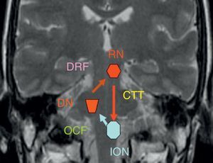 Coronal T2-weighted MR image with schematic of the Guillain–Mollaret triangle. DRF: dentatorubral fibres; OCF: olivocerebellar fibres; DN: dentate nucleus; ION: inferior olivary nucleus; RN: red nucleus; CTT: central tegmental tract.