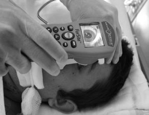 Use of pupillometer in a severely brain-injured patient. In order to obtain valid data, the pupillometer must rest correctly over the orbital area so that it does not move during the examination.