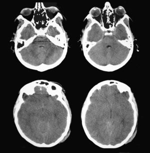 Initial brain CT of a patient with severe head trauma showing a small right temporal contusion. Note that brain CT shows no midline shift.