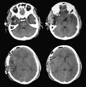 Postoperative brain CT in which both ambient cisterns are visible with no signs of compression.