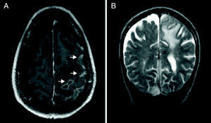 (A) Leptomeningeal impairment and (B) subcortical oedema. T2-weighted MRI sequence with contrast.