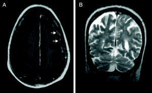 (A) Decrease in leptomeningeal impairment and (B) absence of oedema. T2-weighted MRI sequence with contrast after corticosteroids.