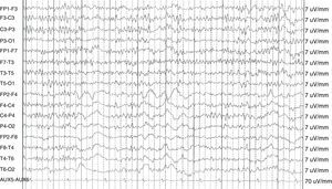 Waking EEG shows an irritative temporal left focus with a normal baseline readout in a patient with pre-ictal psychosis.