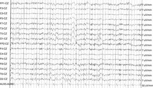 Intercritical waking EEG shows a somewhat slow unstable trace with slower generalised bursts in a patient with postictal psychosis.