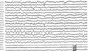 Waking EEG readout showing high-voltage spikes and polyspikes in the left posterior temporal region in a patient with cerebral ganglioglioma, prior to surgery and development of psychosis due to forced normalisation.
