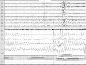 Obstructive apnoea. Polysomnogram taken within 24hours of stroke. Patient was admitted with intracerebral haemorrhage in the basal ganglia and revealed to have frequent obstructive apnoea episodes. The grey line links the respiratory event with the onset of a micro-arousal on the EEG trace.