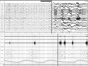 Central apnoea. Polysomnogram taken within 24hours of stroke. Patient was admitted with haemorrhage in the basal ganglia and revealed to have frequent central apnoea episodes. The grey line links the respiratory event with the onset of a micro-arousal on the EEG trace (the snoring signal contains an artefact caused by movement of the patient's legs).