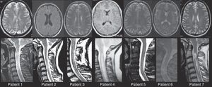 Brain and spinal MRIs for patients 1 through 7. In all cases, we observe extensive myelitis affecting more than 3 vertebral segments with only minimal, non-specific changes in the brain MRI. Spinal MRI studies are T2-weighted sequences. Morphological and hyperintensity characteristics vary because studies were performed at different points in time using different MR units. Brain MRI studies show T2-weighted sequences except for Images 1 and 4, which are T1-weighted sequences with and without gadolinium contrast, respectively.