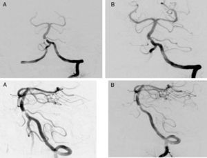 (A) Cerebral arteriography shows stenosis in the lower to middle third of the basilar artery (BA). (B) Cerebral arteriography after placement of a stent in the BA.