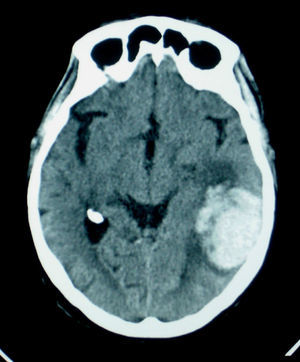 Brain CT. Axial slice left cortical–subcortical temporoparietal haematoma.