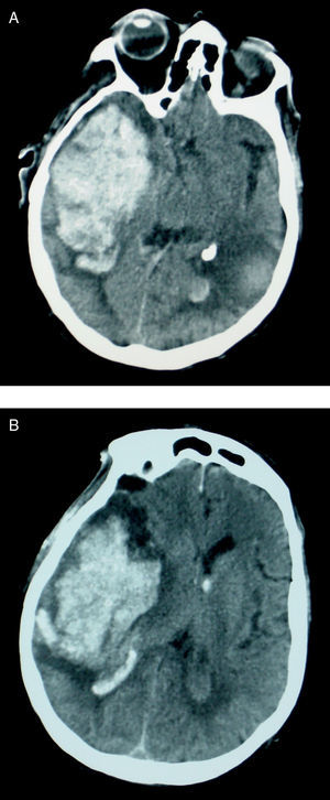 Brain CT. (A) Axial slice. Right acute cortical temporal haematoma and resolving left parietal haematoma and (B) axial slice at the level of the lateral ventricles showing an extensive acute right cortical–subcortical parietal haematoma with a mass effect and bleeding into the lateral ventricles.