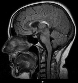 FLAIR MRI sequence with increased uptake in the corpus callosum.