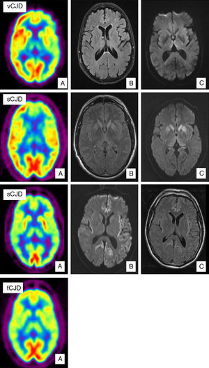 Case of vCJD. (A) PET-FDG shows bilateral thalamic and left hemisphere hypometabolism. (B) FLAIR sequence showing no relevant changes. (C) Bilateral signal increase in the dorsomedial nucleus of the thalamus in diffusion sequences. Case of sCJD. (A) PET-FDG showing hypometabolic areas in the caudate nucleus, thalamus, and anterior region of the putamen. Hypometabolism in the frontal pole and dorsomedial area of the frontal lobe, predominantly on the left side. (B) Bilateral hyperintensities in the basal ganglia and the genu of the left internal capsule in FLAIR sequences. (C) Similar findings in diffusion sequences also showing hyperintensity in the thalamus and cingulate cortex. Probable case of sCJD (MM2 subtype). (A) PET-FDG scan showing generalised reduction in activity in the cortex and both thalamic regions. (B) Bihemispheric, predominantly left-sided cortical hyperintensity in FLAIR sequences. (C) Similar findings in diffusion sequences. Case of fCJD. (A) PET-FDG scan showing predominantly right-sided areas of hypometabolism in the thalamic and basal ganglion regions and bilateral impairment of the caudate nucleus.
