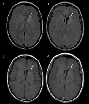 Routine MRI study completed at the 1-month mark shows the change in residual signal that causes retraction of the anterior horn of the lateral ventricle in DP-weighted (A), FLAIR (B) and T1-weighted sequences without contrast (C). No areas showing pathological enhancement were seen after administering contrast (D). All sequences show a nodular hypointense/isointense feature corresponding to the biopsy lesion (arrow).