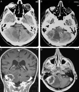 (A and B) CT with and without contrast showing a lesion in the right cerebellar hemisphere. (C and D) Contrast MRI corresponding to the same patient (Patient 18).