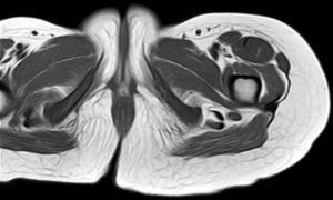 T1-weighted axial MRI of the sciatic notch. Well-defined soft tissue lesion at the left sciatic nerve (hypointense in T1-weighted sequence), lateral to the semimembranosus tendon.