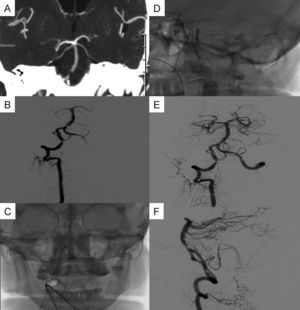 (A and B) Critical stenosis of the proximal third of the basilar artery (CT angiogram and angiography). (C and D) Balloon angioplasty and Wingspan® stent placement. (E and F) The final image (anterior–posterior and lateral view) showing revascularisation of the basilar artery.