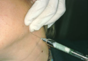 Injection with triamcinolone acetonide at the insertion of the stylomandibular ligament. The needle slopes upward so as to reach the internal face of the mandibular angle, where the ligament insertion site is located.