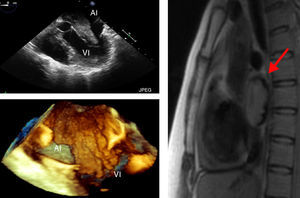 The images in the first column were taken with TEE; above, 2D image showing 5 cavities and below, 3D image showing full volume. Both images reveal a mass with irregular contours on the LA that enters the LV during diastole. The image in the second column is a cardiac MRI slice showing an intra-atrial mass (arrows).