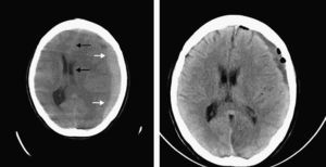 CT Left: acute phase image showing the subdural haematoma (white arrows) and the midline shift (black arrows). Right: haematoma after surgery.