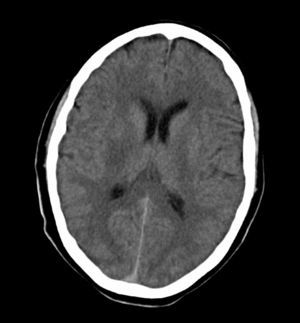 Emergency cranial CT. Hypodense focus in the posterior third of the right putamen.