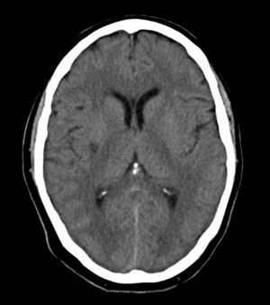 Cranial CT 24hours after IVT. Ischaemic lesion in the posterior third of the right putamen.