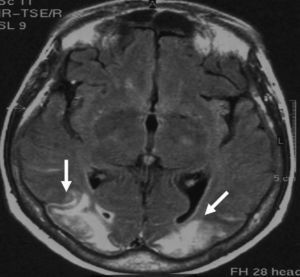 FLAIR Brain MRI. Axial slice showing bilateral extensive hyperintense cortical and subcortical lesions (white arrows) in both occipital lobes.