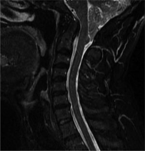 Sagittal, fat-suppressed cervical MR image revealing ectopia of the cerebellar tonsils 16mm below the foramen magnum, angled medulla, and decreased subarachnoid space at the craniocervical junction.