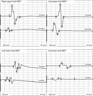 Normal MEP findings corresponding to the short abductor muscle of the thumb (upper limbs) and the anterior tibialis muscle (lower limbs).