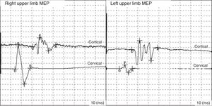 Abnormal MEP findings from the abductor muscle of the thumb: increase in cortical MEP latency (right: 24.5ms; left: 30ms) and increase in central motor conduction time (right: 16.5ms; left: 11.8ms).