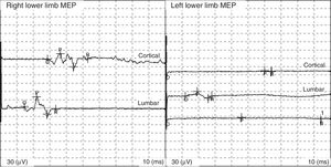 The study yielded abnormal MEP findings in the left lower limb (anterior tibialis muscle): no MEPs produced by cortical stimulation.