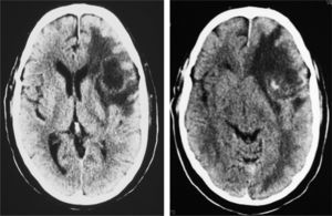 Brain CT without contrast showing a space-occupying lesion in the left frontal–temporal area with significant perilesional oedema and a midline shift.