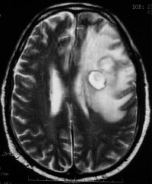 Brain MRI, T2-weighted sequence.
