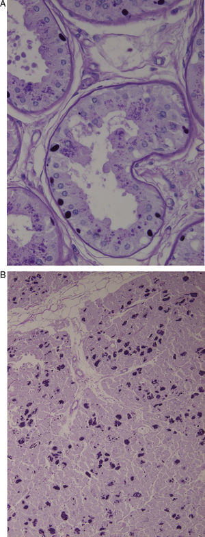 (A) Axillary skin biopsy (PAS stain, 2×400 magnification) showing round-shaped intensely PAS-positive formations in the epithelial cells of the apocrine glands and in the ducts of the eccrine glands which correspond to Lafora bodies. (B) Heart (PAS stain, 1×200 magnification). Multiple Lafora bodies in myocytes.