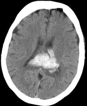 Computed tomography showing a haematoma of the splenium of the corpus callosum in the patient with acute presentation.