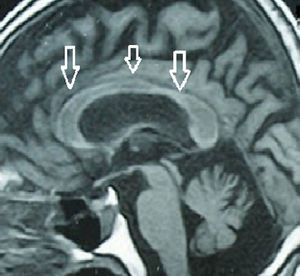 Brain MRI showing atrophy along the entire corpus callosum, indicated with white arrows, in the patient with chronic presentation.