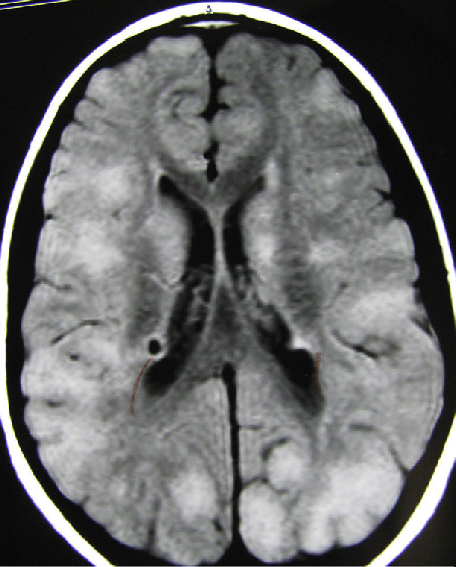 Significance of tuber size for complications of tuberous sclerosis ...