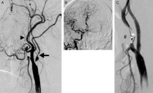 (A) Carotid artery near-occlusion meeting all qualitative criteria for that definition: internal carotid artery (arrow) with a diameter smaller than that of the external carotid (arrowhead); distal opacification in the territory of the internal carotid, which is smaller than the external carotid (*); compensation by collateral intracranial circulation (B). (C) Result after placement of Cristallo stent (Invatec-Medtronic). The inflated distal balloon (#) of the MoMa device (Invatec-Medtronic) can be seen at the origin of the external carotid artery.