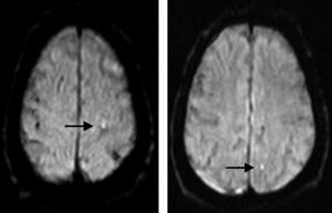 Magnetic resonance image with diffusion-weighted sequence showing punctiform hyperintense features that indicate areas of restricted diffusion and therefore periprocedural infarct (arrows). These features appeared in the white matter of the left parietal lobe, ipsilateral to the revascularised carotid artery.