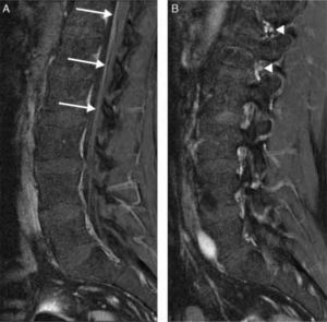 Fat-suppressed T1-weighted MR images with gadolinium contrast. (A) Marked enhancement of the cauda equina roots showing thickening (arrows). (B) MRI of the right intervertebral foramina showing enhancement of L1 and L2 (arrowheads).